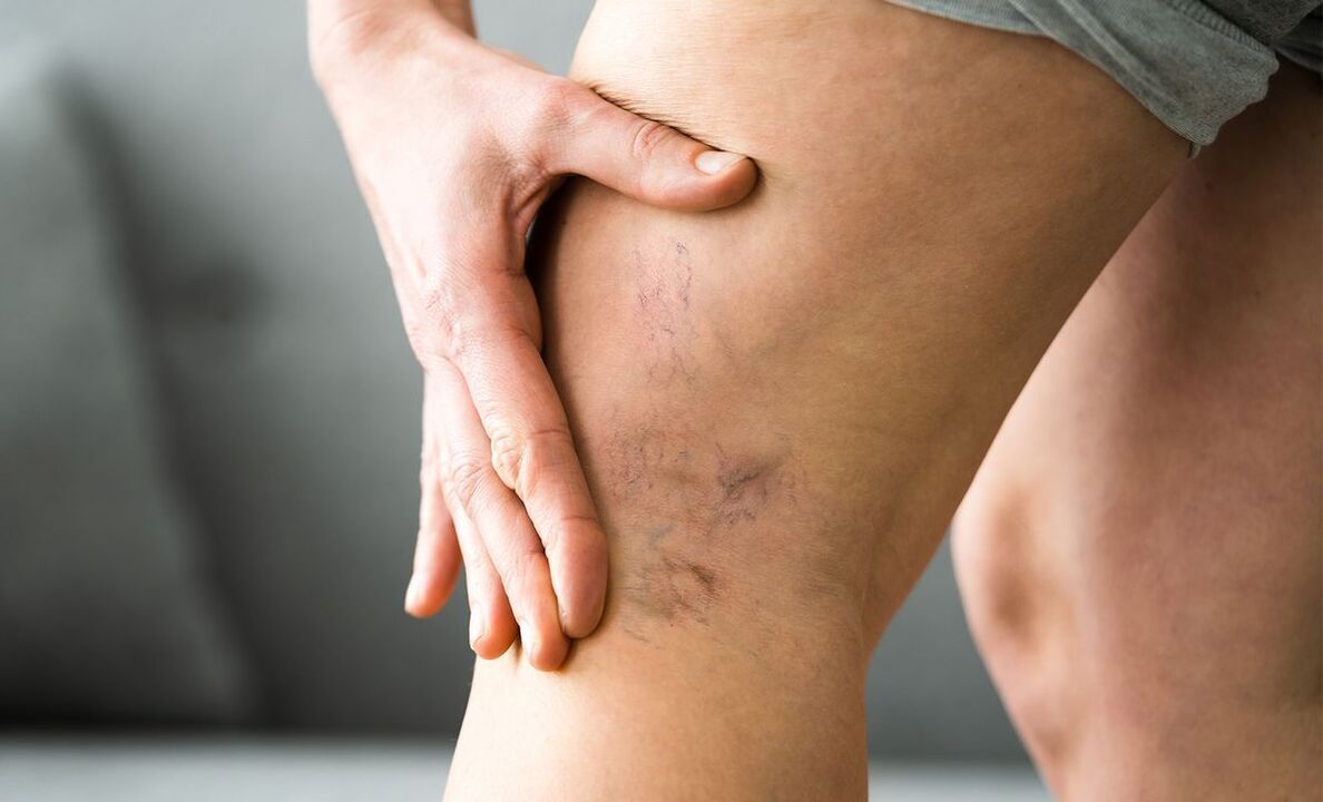 symptoms of varicose veins